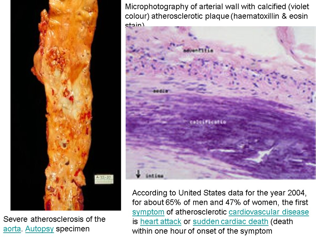 Severe atherosclerosis of the aorta. Autopsy specimen Microphotography of arterial wall with calcified (violet